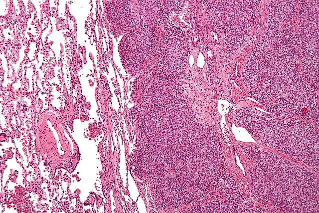 File:Ewings sarcoma histology 2.jpg