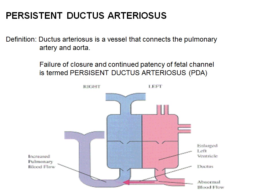 Pictoral illustration of patent ductus arteriosus