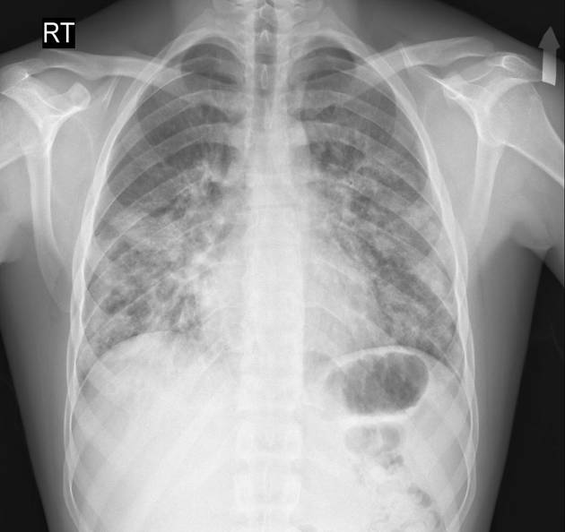 Acute eosinophilic pneumonia x-ray, source: Case courtesy of Dr Yair Glick, Radiopaedia.org, rID: 53840