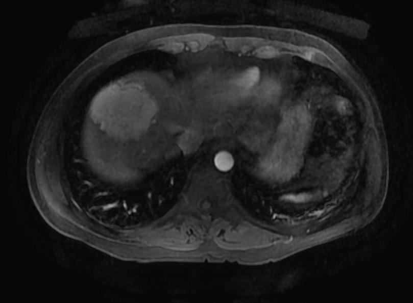 File:Focal nodular hyperplasia MRI 105.jpg