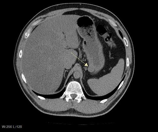 File:GIST CT-Noncontrast image.jpg