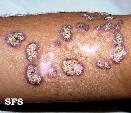 File:Lupus erythematosus chronicus verrucous07.jpg