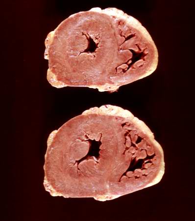 This is a gross photograph of the heart from this case. There is thickening of the left ventricular wall and some thickening of the right ventricle as well.