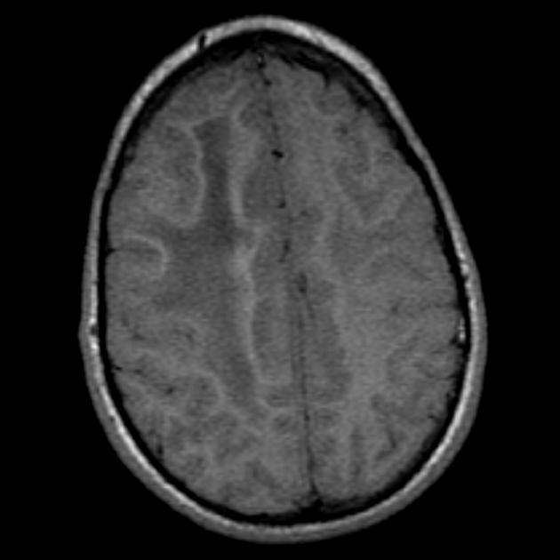 T1 MRI of gliomatosis cerebri.[2]