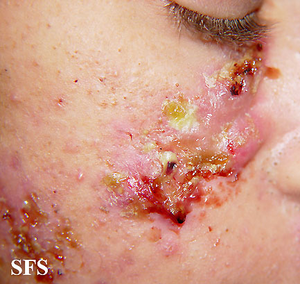 Acne necrotica. Adapted from [http://www.atlasdermatologico.com.br/disease.jsf?diseaseId=4
