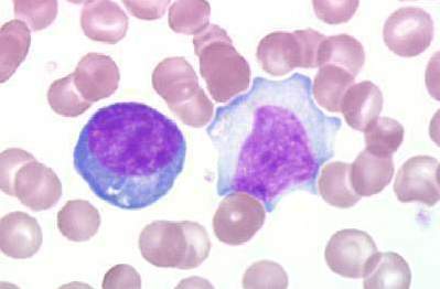An atypical lymphocyte.