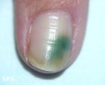 Green nails. With permission of Dermatology Atlas