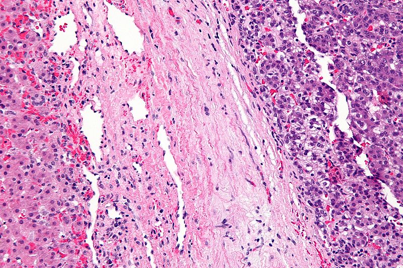 High magnification micrograph of a hepatoblastoma, a type of liver cancer found in infants and young children. H&E stain[7]