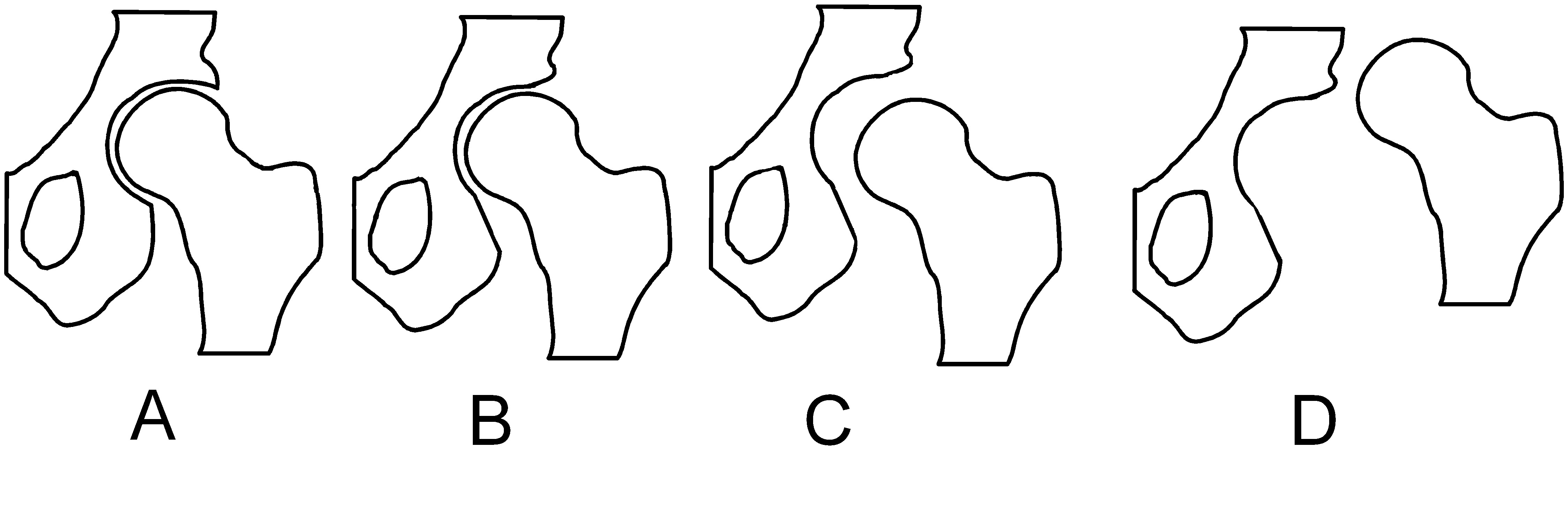 File:Hip dysplasia - schematic.jpg