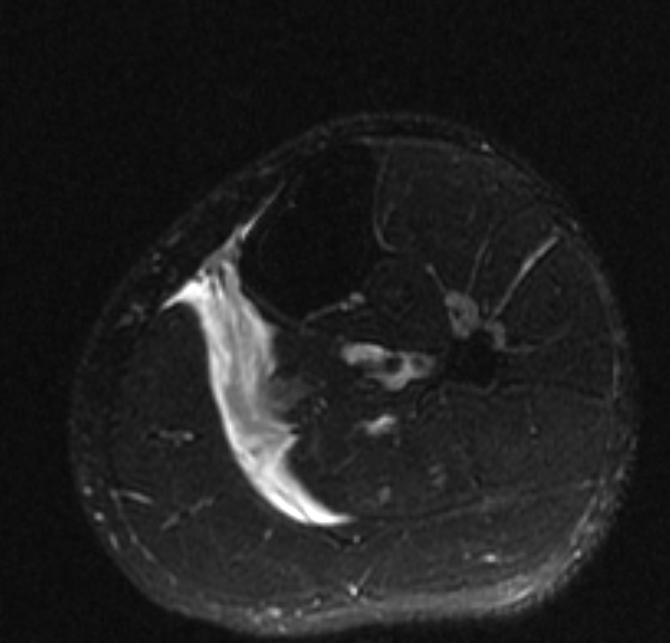 File:Plantaris rupture MRI 005.jpg