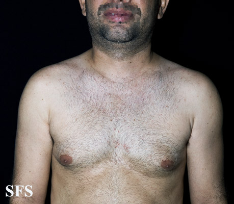 Acquired hypomelanosis-hipopigmentation after sympathectomy. Adapted from [http://www.atlasdermatologico.com.br/disease.jsf?diseaseId=8