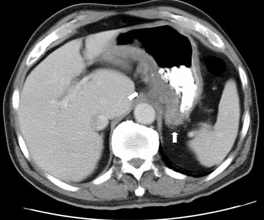 CT scan showing Crohn's disease in the fundus of the stomach