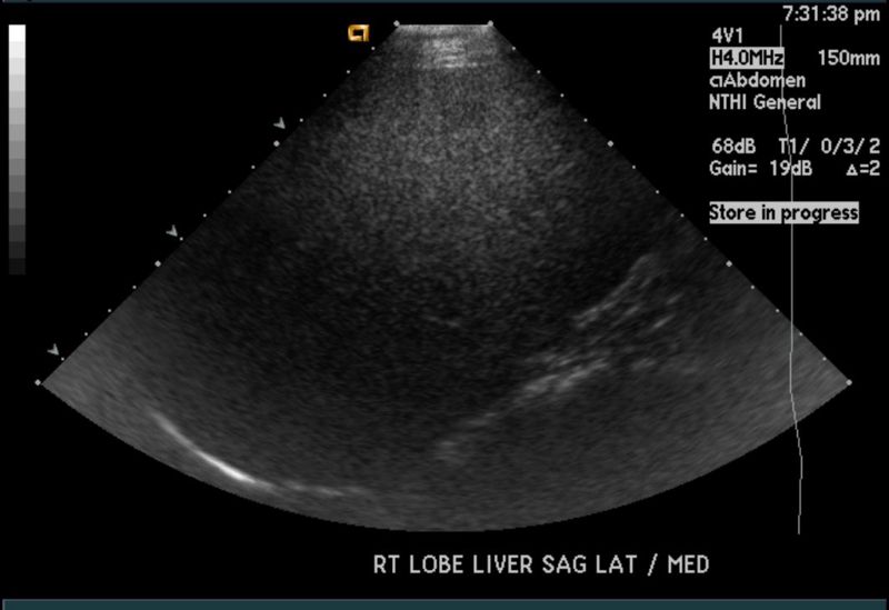 File:Fatty infiltration of liver ultrasound 001.jpg