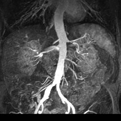 High grade left main renal artery stenosis, MRA. 76 year old male with hypertension.