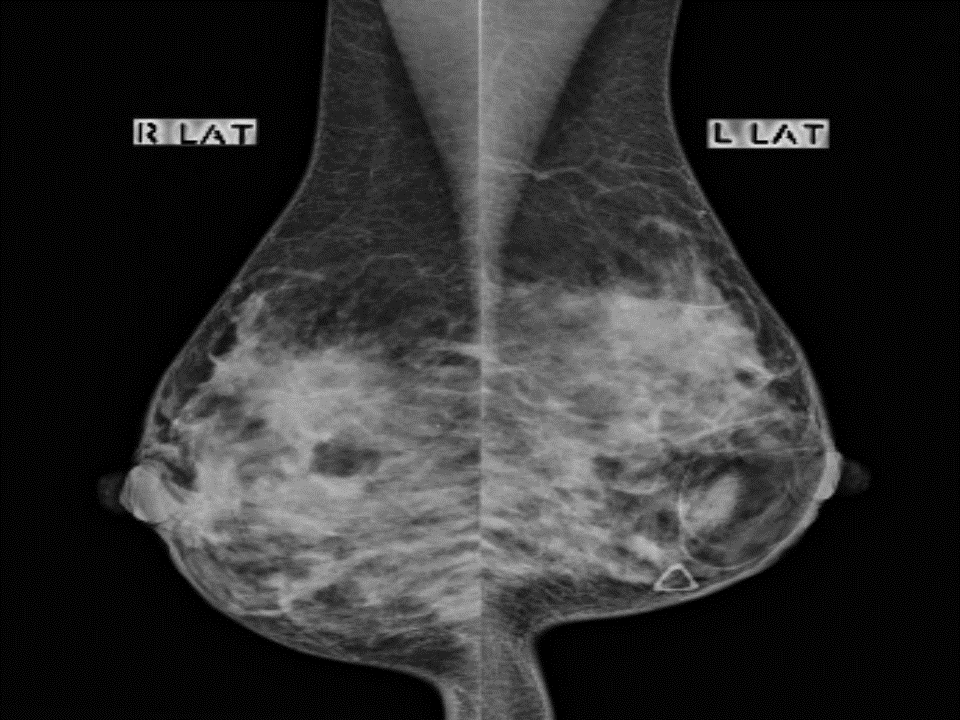 File:Breast hamartoma mammography.gif