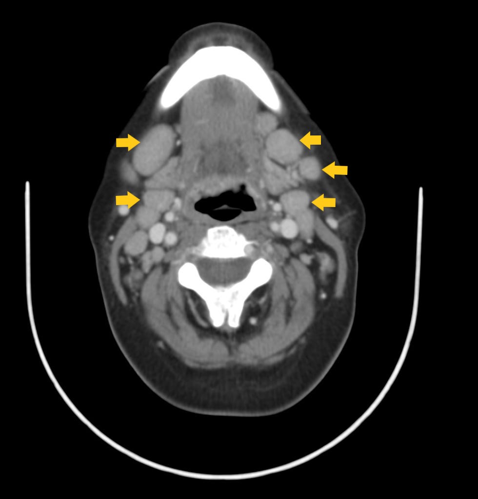 File:Cervical lymphadenopathy CT.jpg