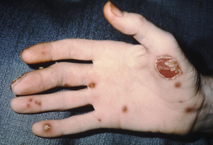 Patient’s right hand exhibited pustules on the palm and fingers, which is a symptom of his diagnosed “Reiter’s syndrome”. From Public Health Image Library (PHIL). [1]
