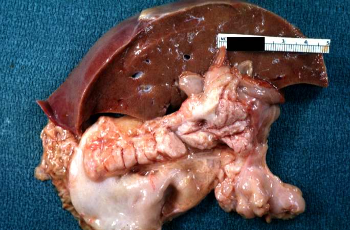 A gross photograph of liver and pancreas from the autopsy. The pancreas is slightly smaller than normal and it has a mucous consistency.