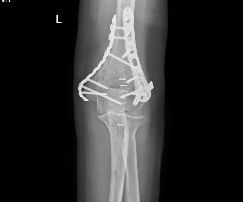 File:Displaced-t-condylar-and-supracondylar-fracture-of-the-distal-humerus (11).jpg