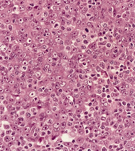 Nasopharyngeal carcinoma - in a LN - intermed. mag. (WC)