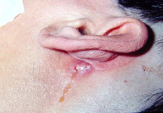 This patient has a recurrent cholesteatoma which has found its way to the surface of the post-auricular skin, forming a mastoid cutaneous fistula.[5]