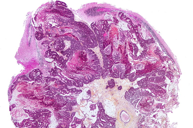 Very low magnification micrograph demonstrating metastatic adenocarcinoma that was shown to be a colorectal primary, i.e. colorectal carcinoma, by immunostains on HPS stain. The cerebellum seen on the image has Bergmann gliosis and Purkinje cell loss.[4]