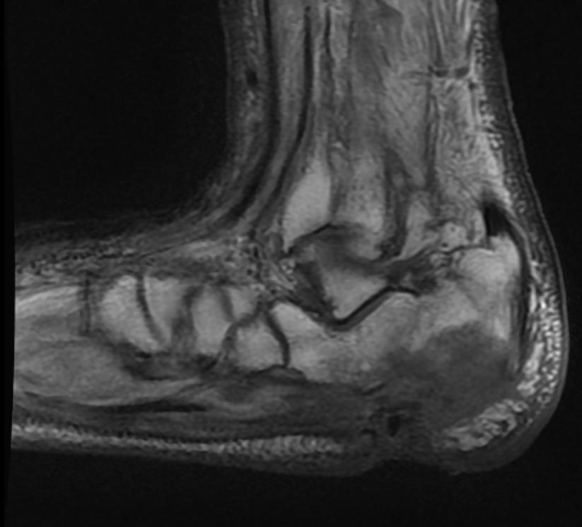 File:Osteomyelitis MRI 001.jpg