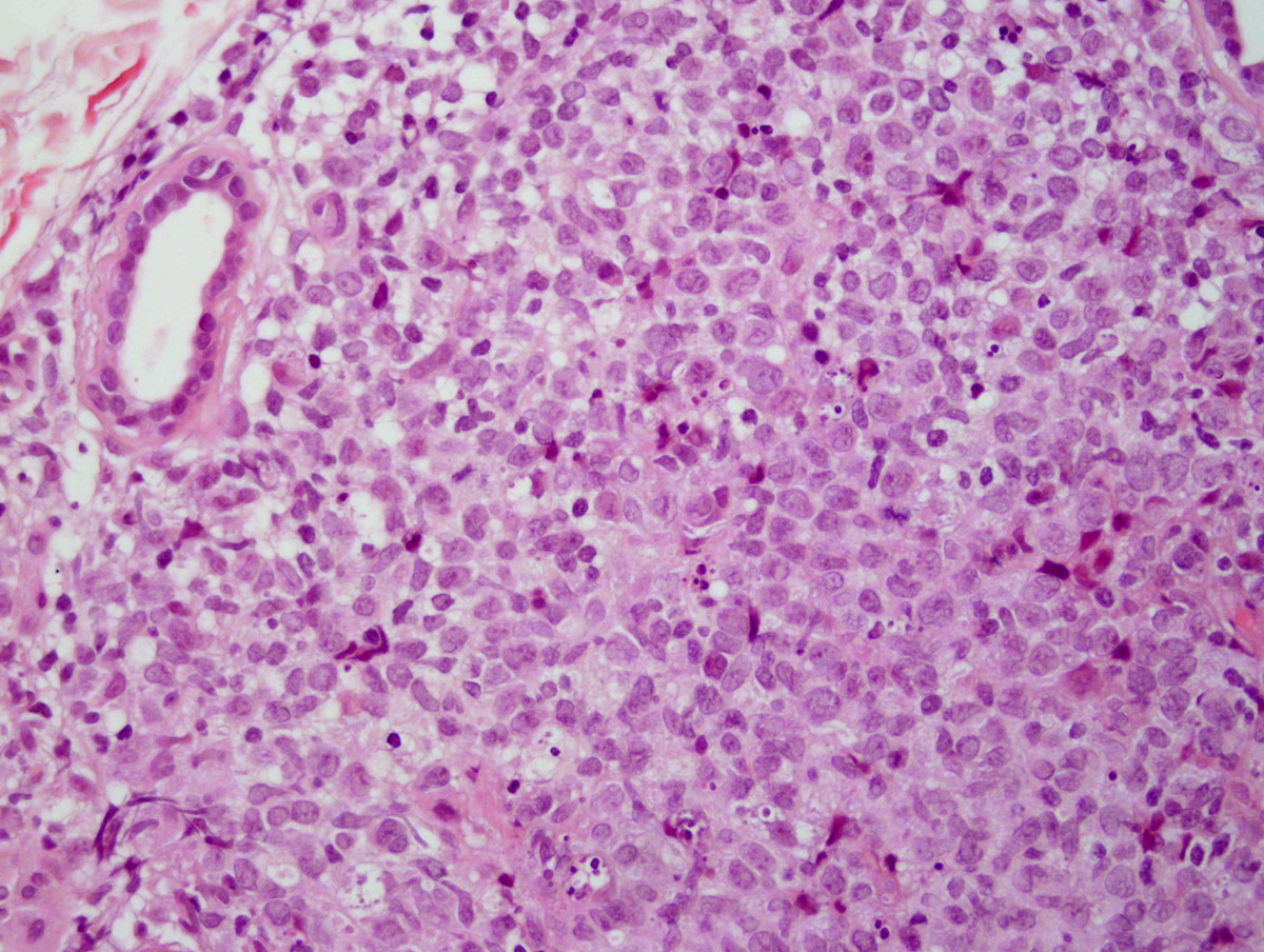 File:Primary cutaneous follicle centre lymphoma image 07.jpg