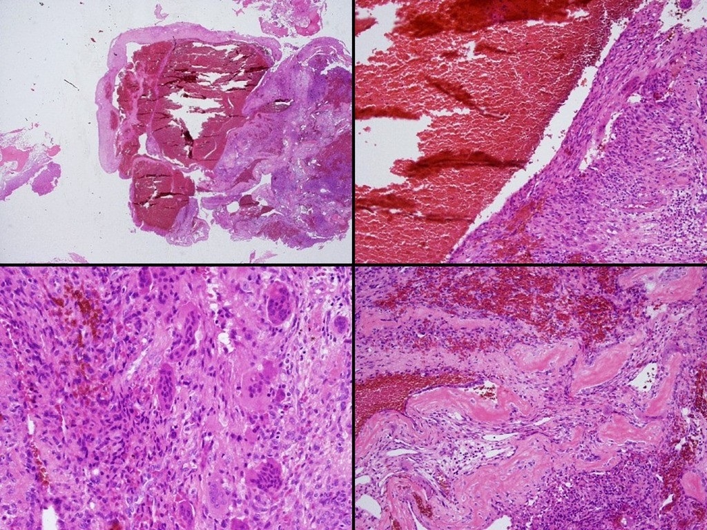 File:Aneurysmal-bone-cyst pathology.jpg