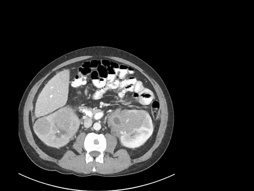 Multiple mass lesions are demonstrated within the hepatic parenchyma with the largest lying in segment 2 and this appears to have several associated mass lesions adjacent to it.[7]