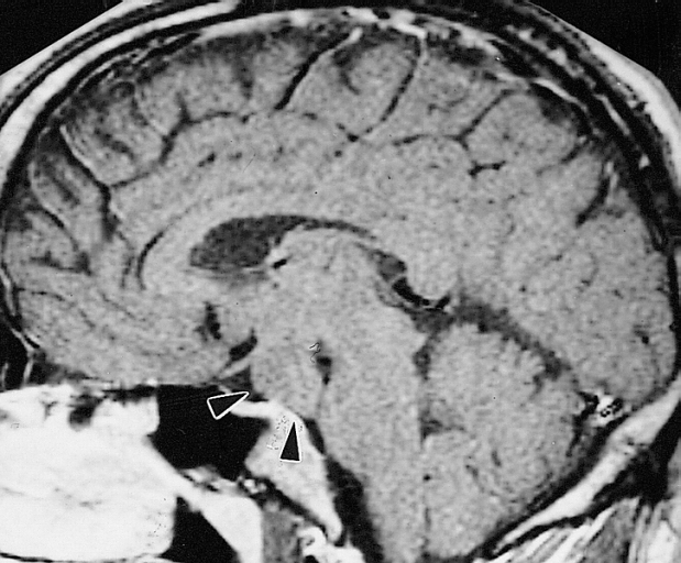 MRI showing hypothalamic hamartoma(Images courtesy of RadsWiki)