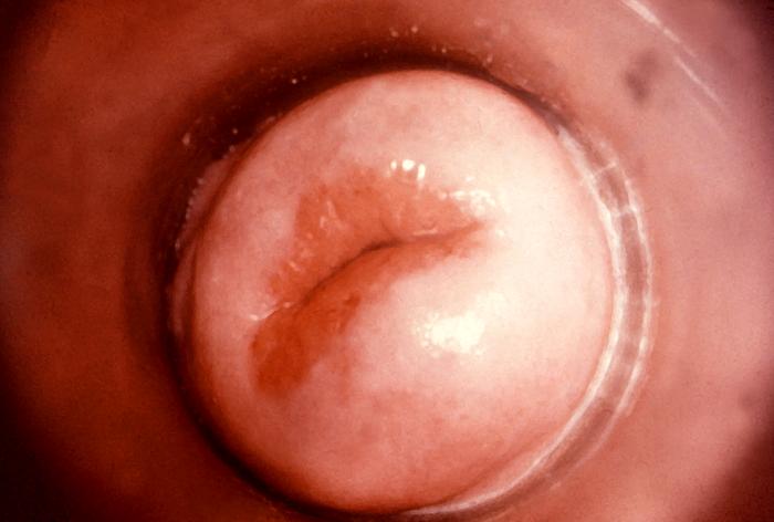 This colposcopic view of this patient’s cervix reveled an eroded ostium due to Neisseria gonorrhea infection. A chronic Neisseria gonorrhea infection can lead to complications, which can be apparent such as this cervical inflammation, and some can be quite insipid, giving the impression that the infection has subsided, while treatment is still needed.Adapted from CDC