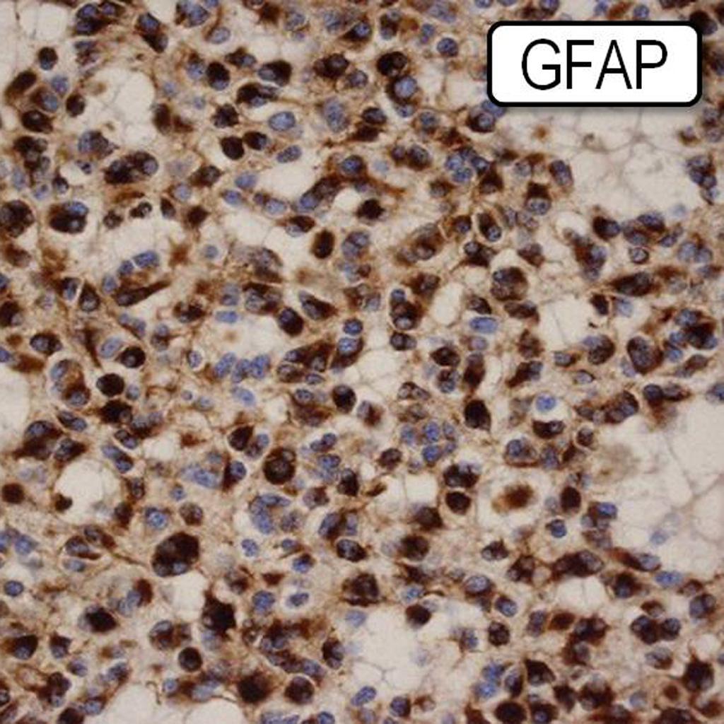 Histology of oligoastrocytoma cells demonstrating positivity to tumor marker GFAP.[21]