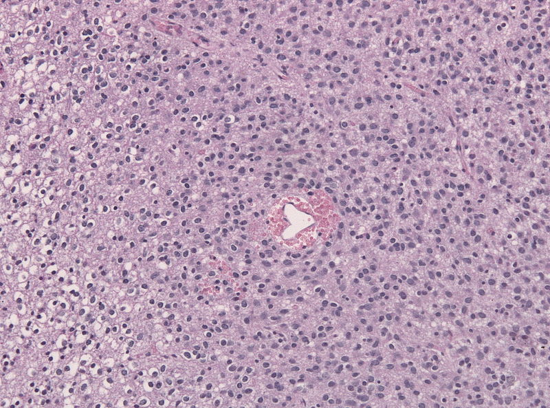 Biopsy specimen of an oligoastrocytoma (HE stain).[23]