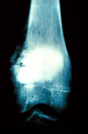 This is another view of the tumor in the distal femur.