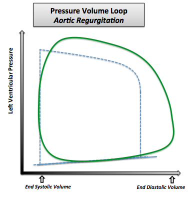 File:Pressure Volume Loop Aortic Regurgitation.png