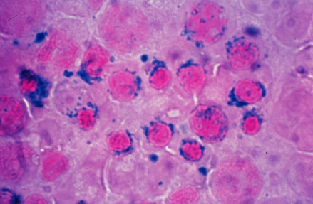 Sideroblastic (microcytic) anemia.jpg