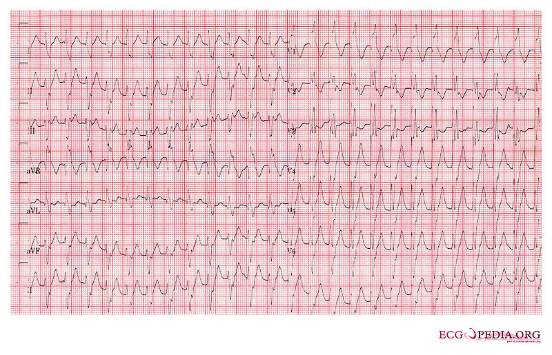 File:Ventricular Tachycardia 4.jpg