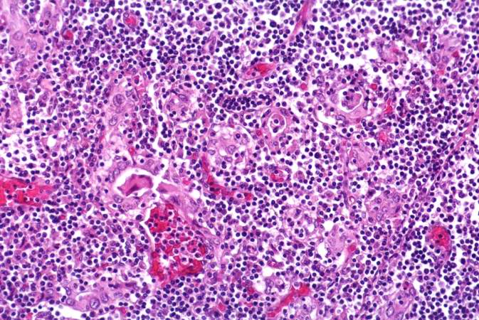 This is a high-power photomicrograph showing the lymphocytes and plasma cells surrounding the thyroid gland epithelium.