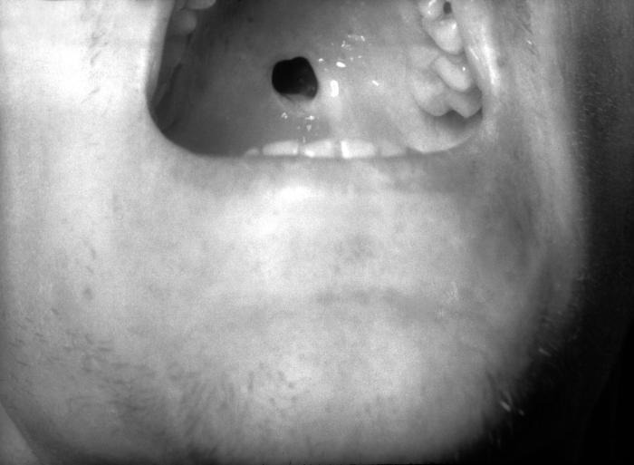 This image depicts the dentition of a congenital syphilis patient, who due to this disease, went on to develop what are known as mulberry molars. “Moon's“, or mulberry molars, is a condition where the bite surface of the permanent first lower molar teeth develops rounded surfaces to its cusps, resembling the surface of a mulberry. Congenital syphilis, is a condition caused by infection in utero with Treponema pallidum. A wide spectrum of severity exists, and only severe cases are clinically apparent at birth. An infant or child (aged less than 2 years) may have signs such as hepatosplenomegaly, rash, condyloma lata, snuffles, jaundice (nonviral hepatitis), pseudoparalysis, anemia, or edema (nephrotic syndrome and/or malnutrition). An older child may have stigmata (e.g., interstitial keratitis, nerve deafness, anterior bowing of shins, frontal bossing, mulberry molars, Hutchinson teeth, saddle nose, rhagades, or Clutton joints). Adapted from CDC