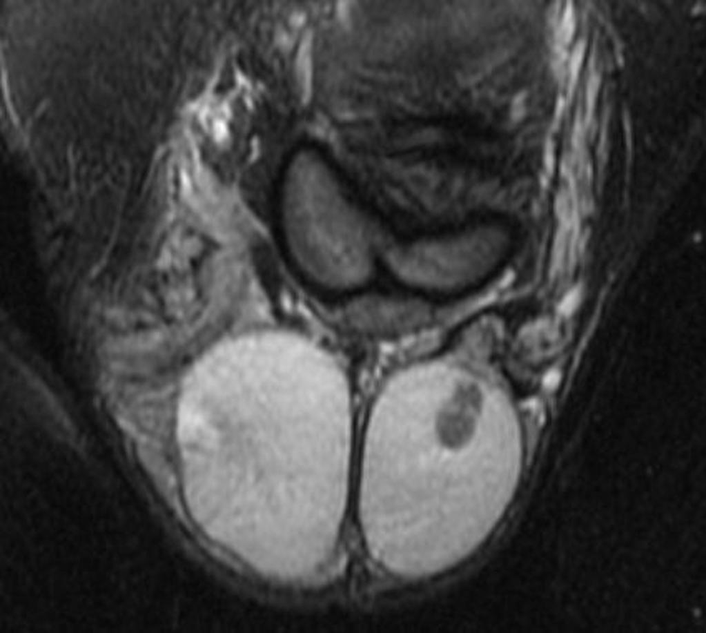 File:Seminoma in MRI (2).jpg
