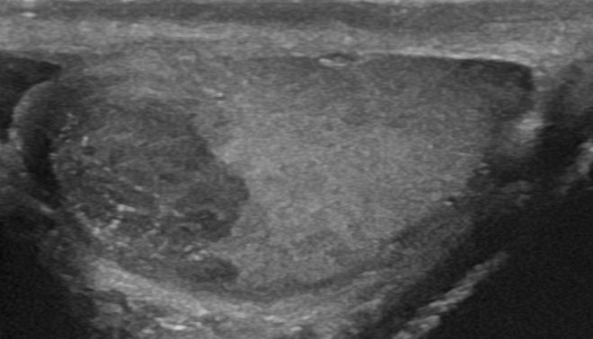 File:Seminoma in ultrasound (2).jpg