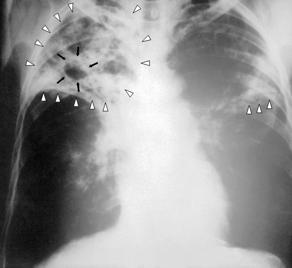 File:Tuberculosis Chest X-ray.jpg