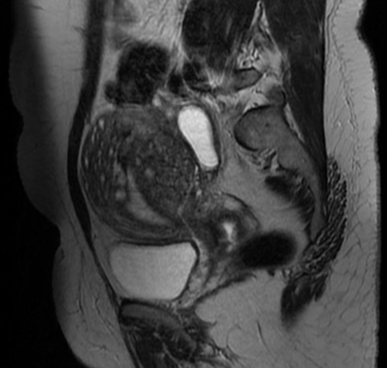 File:Adenomyosis MRI 106.jpg