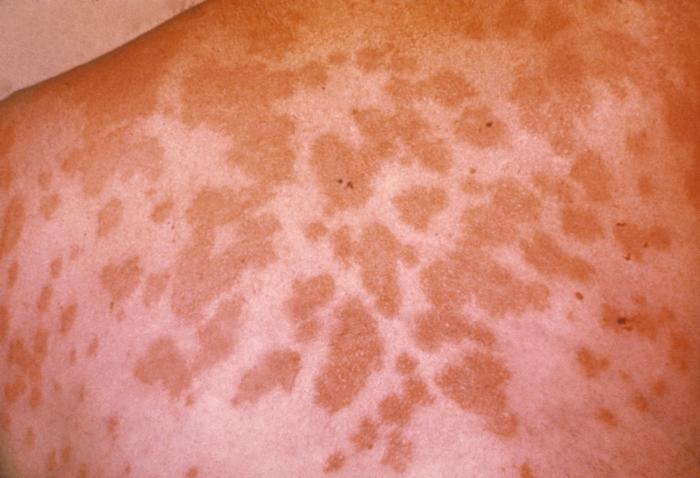 Erythema nodosum lesions on skin of back due to hypersensitivity to antigens of Coccidioides immitis. From Public Health Image Library (PHIL). [6]