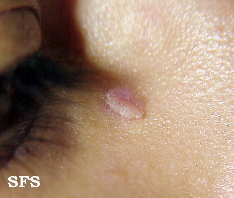 Warts formis. Adapted from Dermatology Atlas.[1]