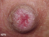 Paget's disease. With permission from Dermatology Atlas.[1]