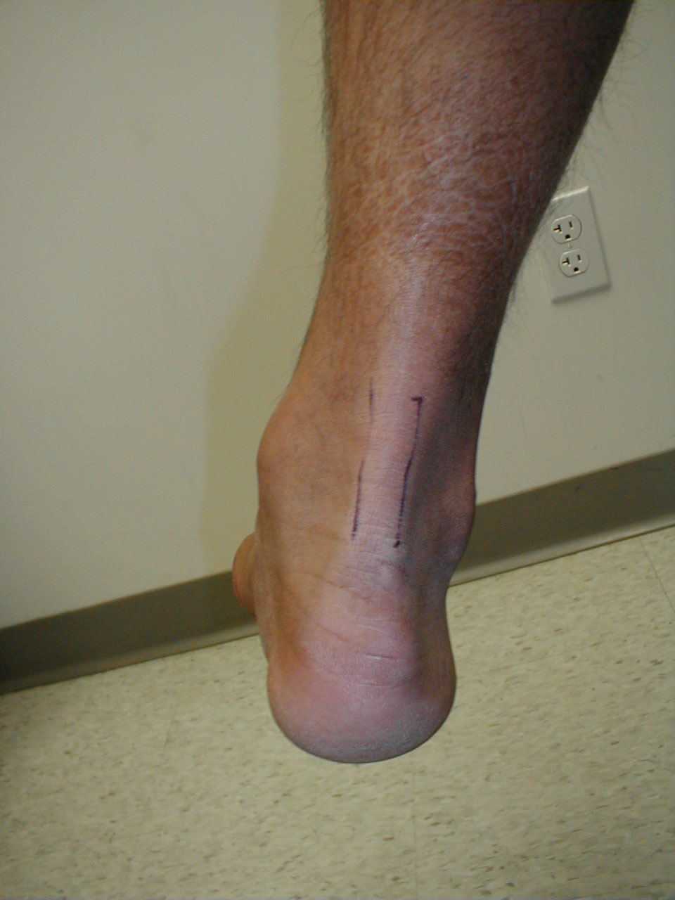 Achilles tendon:Tendon is outlined