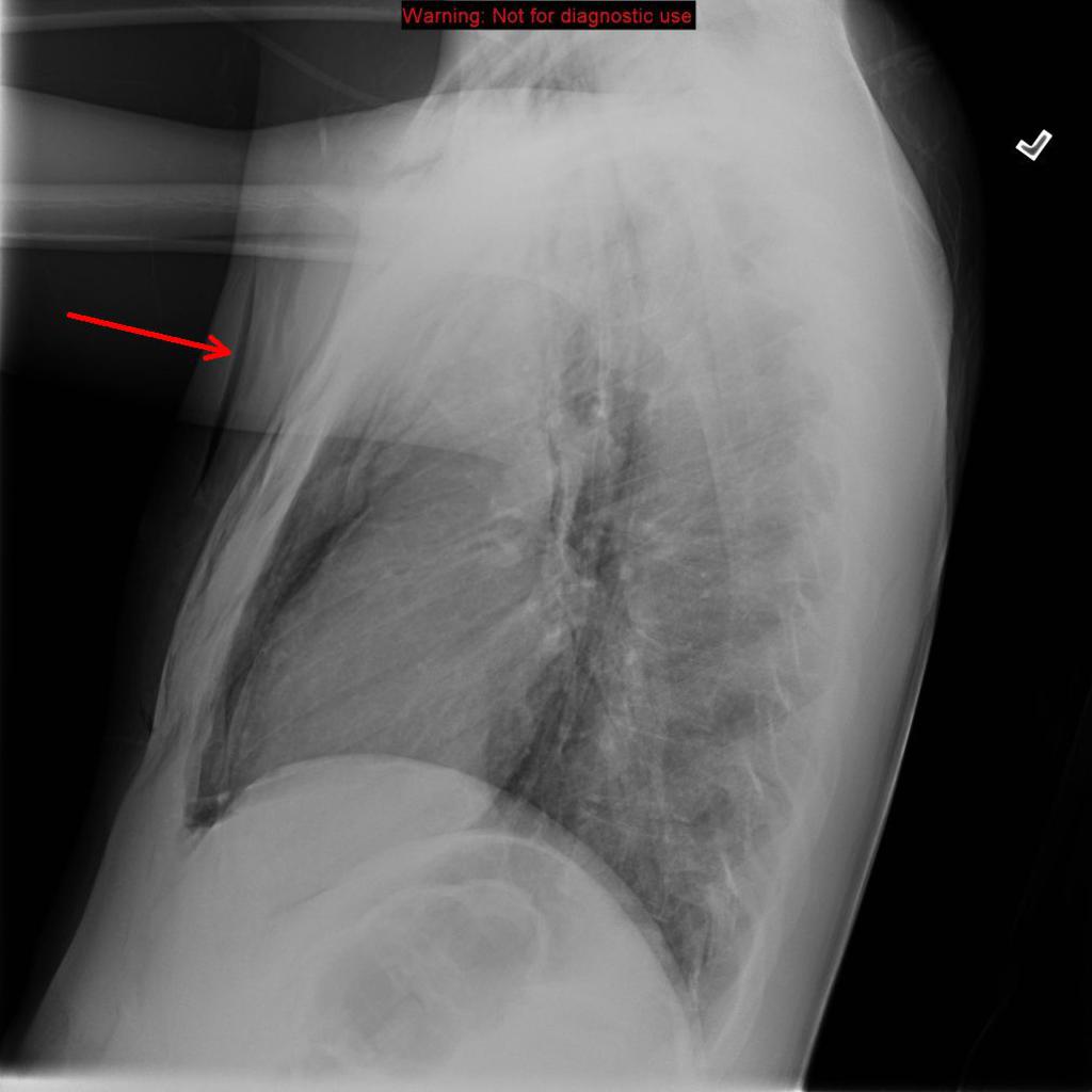 Chest X-ray: Boerhaave syndrome- Lateral radiographs subcutaneous emphysema (red arrow) along the chest wall; Source- Radiopaedia