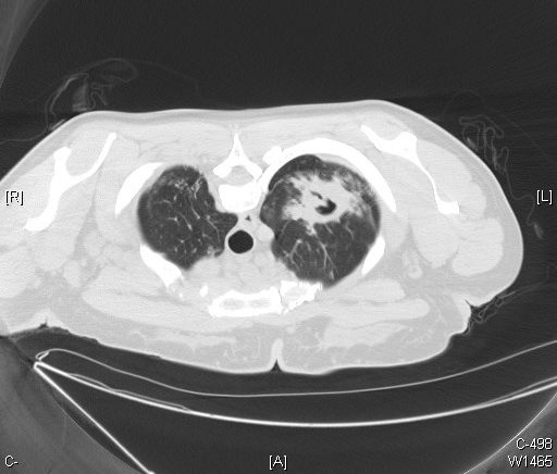 File:Cavitary tuberculosis - CT scan.jpg